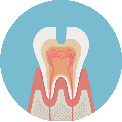 エナメル質を貫通してむし歯が象牙質まで達している