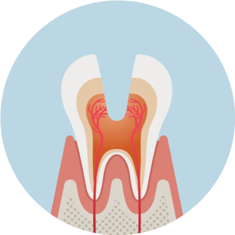 神経まで進んだ虫歯