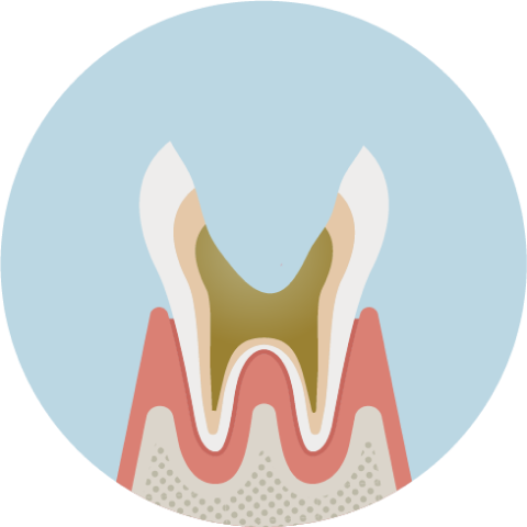 歯根だけ残った虫歯