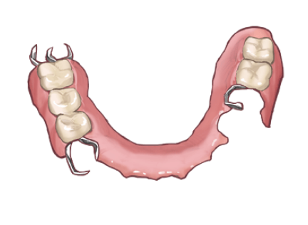部分入れ歯