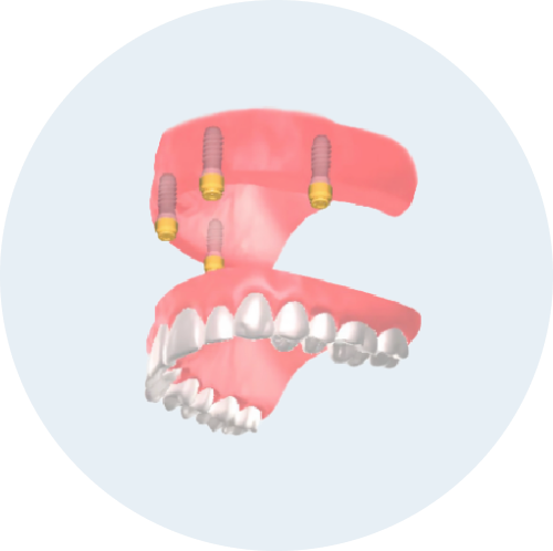 インプラントオーバーデンチャー