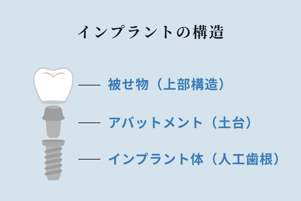 インプラントの構造