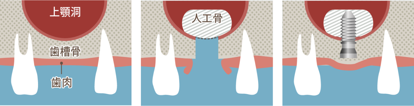 ソケットリフト