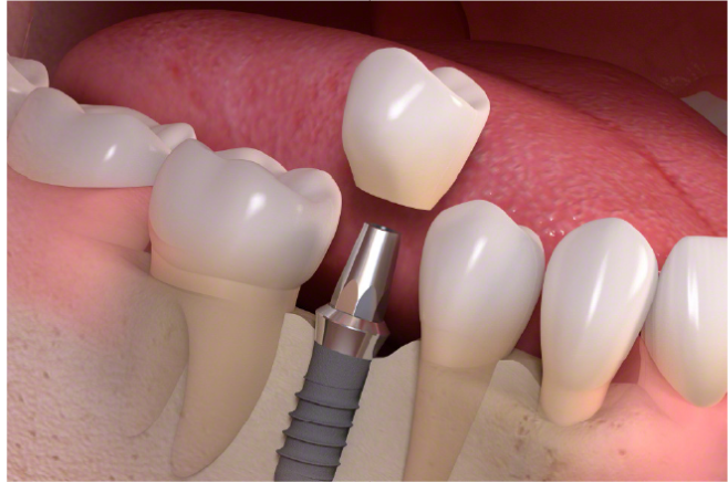上部構造（被せ物）の装着