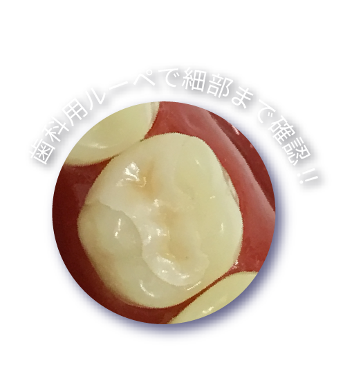歯科用ルーペで拡大