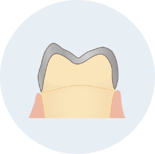 メタルインレー/メタルクラウン