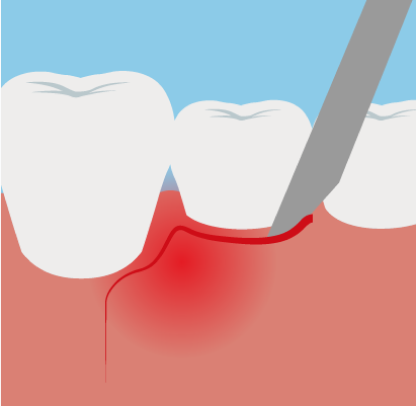 歯肉の切開