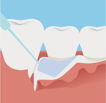 歯周組織を再生させる薬剤を塗布