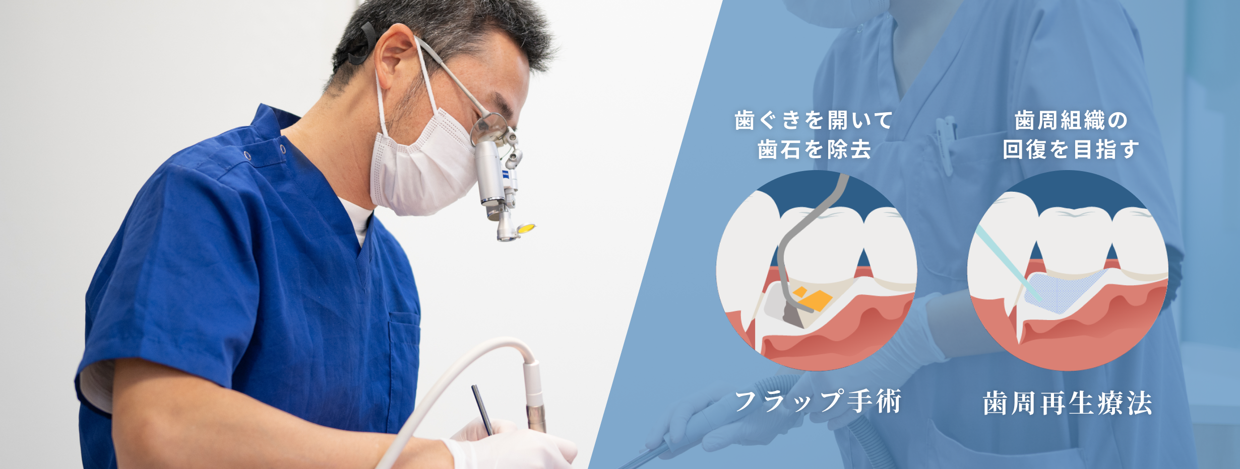 フラップ手術・歯周再生療法