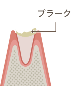 歯周炎
