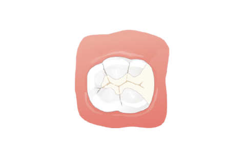 セラミックインレー