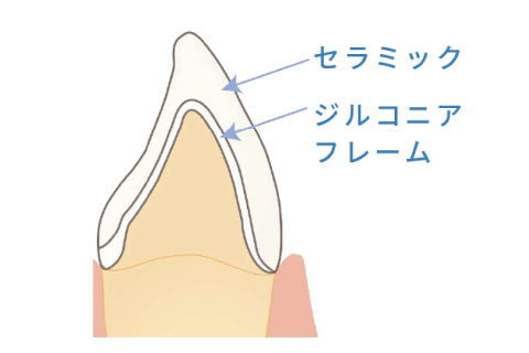 ジルコニアセラミック冠