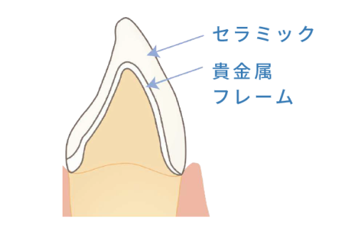 メタルセラミック冠