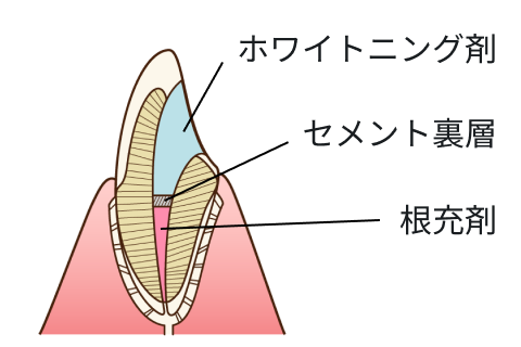 ウォーキングブリーチ