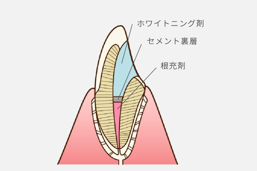 ウォーキングブリーチ